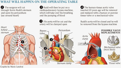 proses pembedahan jantung